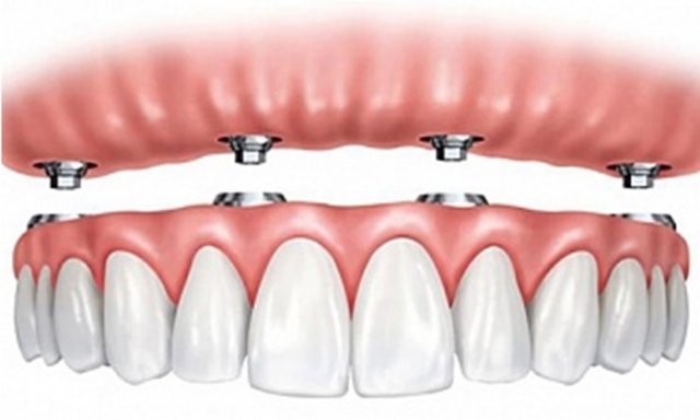 Имплантация зубов по протоколу немедленной нагрузки: преимущества и особенности метода